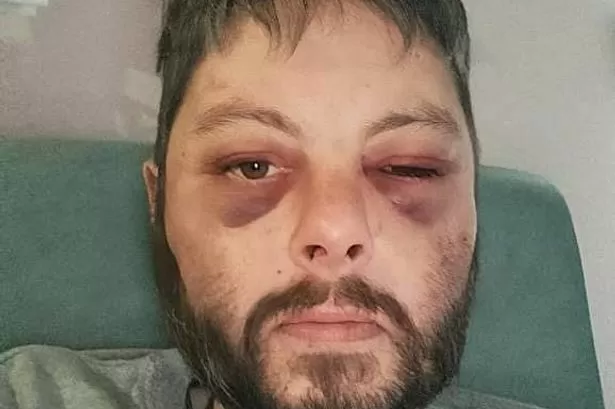 Artist's bruised face after partner's two-hour attack that killed him