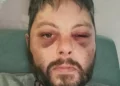 Artist’s bruised face after partner’s two-hour attack that killed him